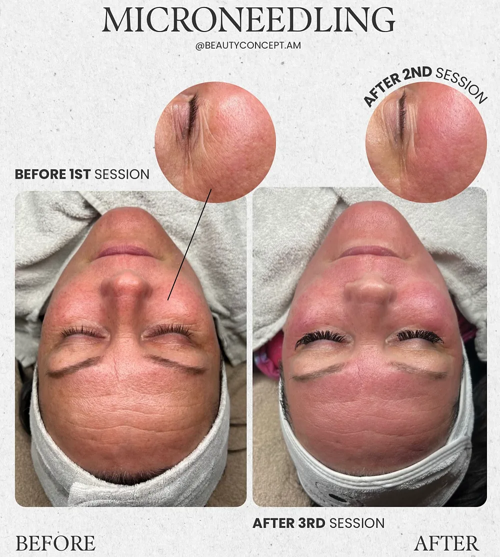 Microneedling Verlauf: vor der ersten Sitzung sowie nach der zweiten und dritten Sitzung